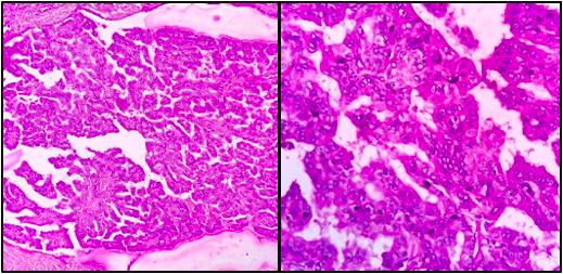 Papillary Thyroid Carcinoma – An Update On Rare Variants And Its Cytohistopathological Correlation