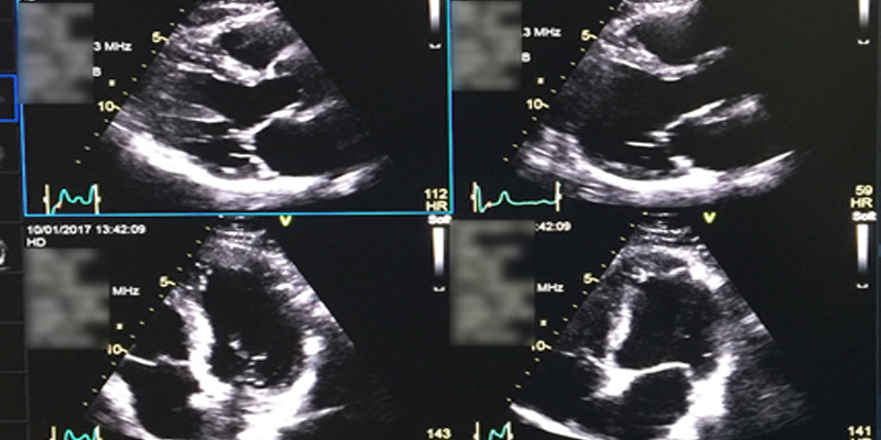 Is any other test done in place of stress echocardiography in patients who can’t exercise?