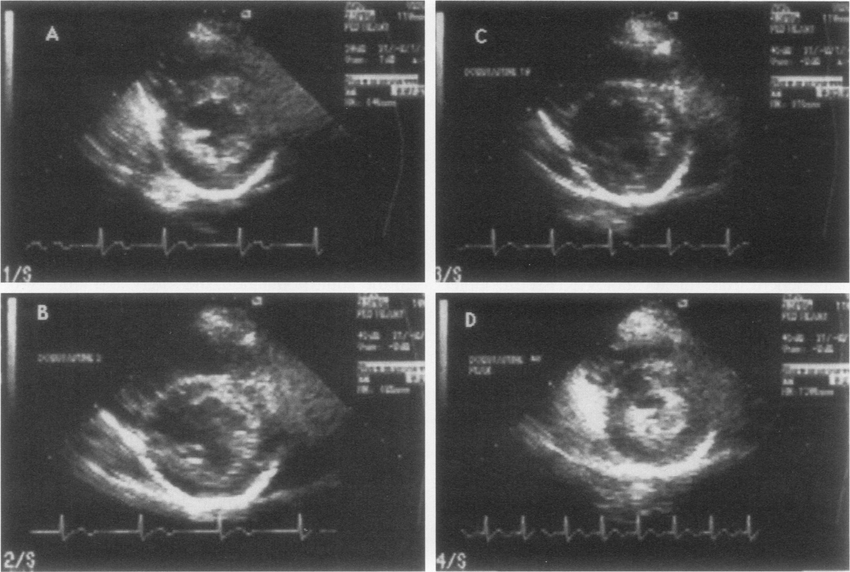 What is Stress Echocardiography?