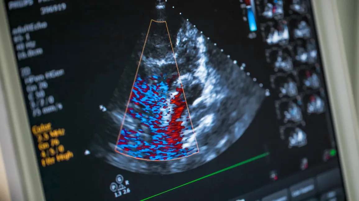 Who should undergo Echocardiography?